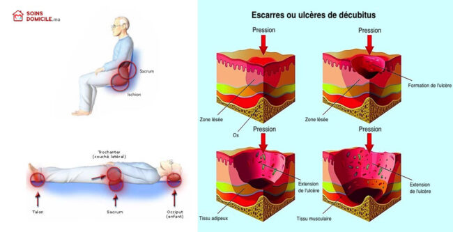 escarres-infirmiers-prevention