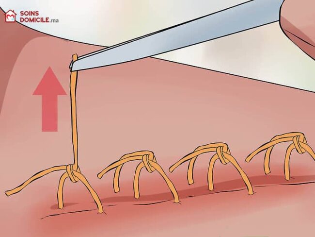 ablation fils suture domicile Casablanca ablation fils suture domicile Casablanca