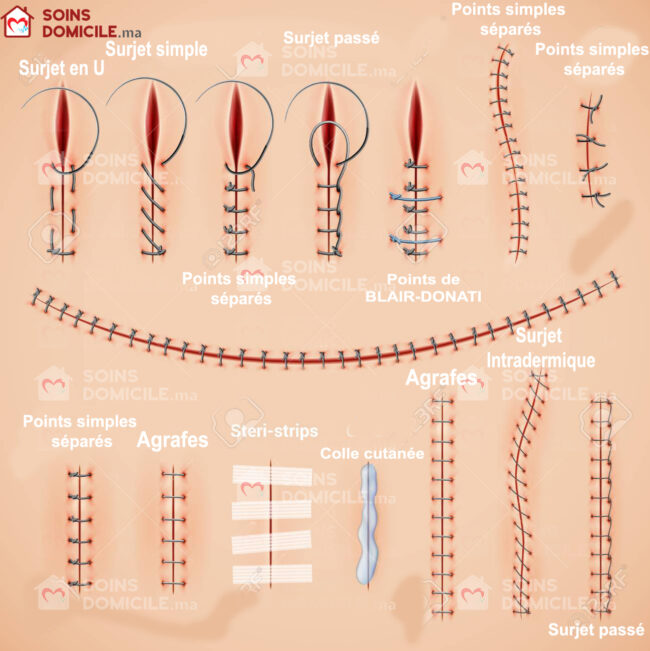 types de points de sutures