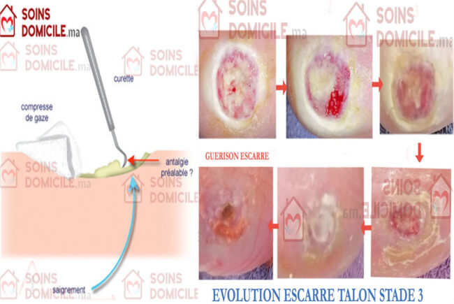 escarres talon domicile Casablanca escarres talon domicile Casablanca